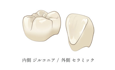 内側 ジルコニア /  外側 セラミック