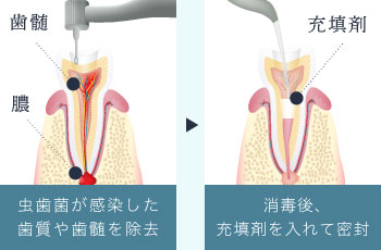 虫歯菌が感染した歯質や歯髄を除去→消毒後、充填剤を入れて密封